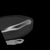 SPORK, NICO - 22.03.1976 - 02.08.2022 - CT obere Extremität - 18:02:23